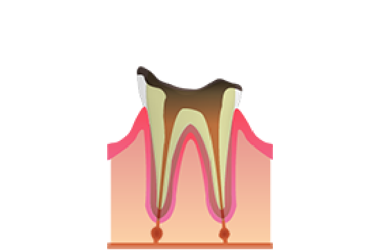歯根だけ残った虫歯