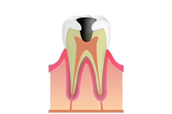 歯の神経まで進行した虫歯